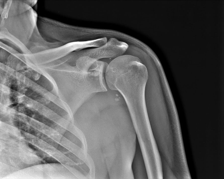 Radiographie de l'arthrose de l'articulation de l'épaule, 2e degré de gravité