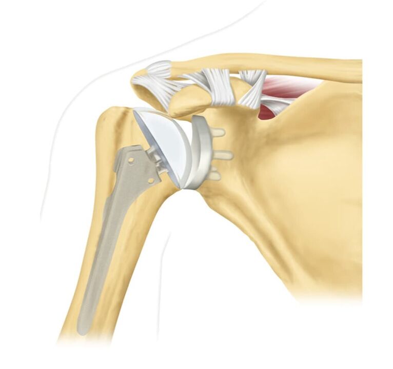 Remplacement d'une articulation de l'épaule endommagée par une endoprothèse