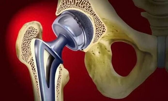 Remplacement de la hanche pour l'arthrose