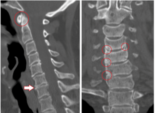 Le scanner montre des vertèbres et des disques intervertébraux endommagés de hauteur hétérogène en raison d'une ostéochondrose thoracique