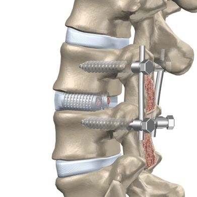 Remplacement d'un disque intervertébral détruit de la colonne thoracique par un implant artificiel