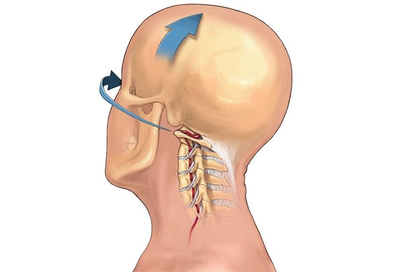 Grincement du cou en tournant la tête comme symptôme d'ostéochondrose cervicale