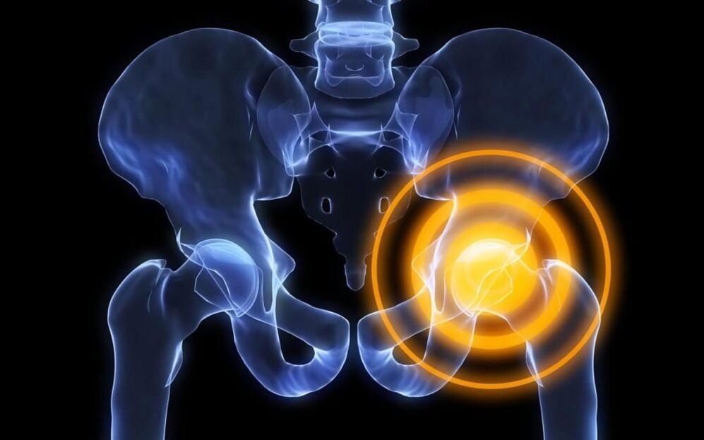Image de douleur articulaire de la hanche 2
