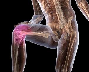 Inflammation de l'articulation du genou avec arthrose