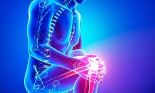 Stades de l'arthrose de l'articulation du genou