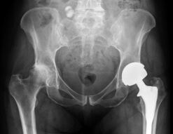 Diagnostic de l'arthrose de la hanche