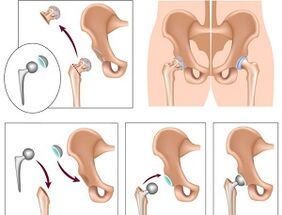 Endoprothèses pour l'arthrose de la hanche